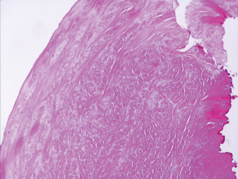 Histological Study of Discoid Lateral Meniscus in Children and Adolescents: Morphogenetic Considerations.