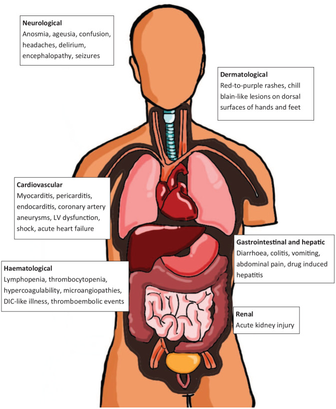 Multisystem Inflammatory Syndrome in Children and Adolescents (MIS-C) under the Setting of COVID-19: A Review of Clinical Presentation, Workup and Management.