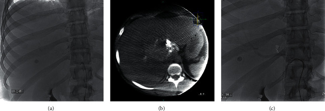 From an Incidental Finding to an Emergent Treatment: A Case Report of a Hepatic Adenomatosis and Large Ruptured Hepatic Adenoma.