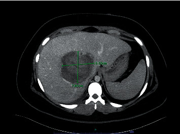 From an Incidental Finding to an Emergent Treatment: A Case Report of a Hepatic Adenomatosis and Large Ruptured Hepatic Adenoma.