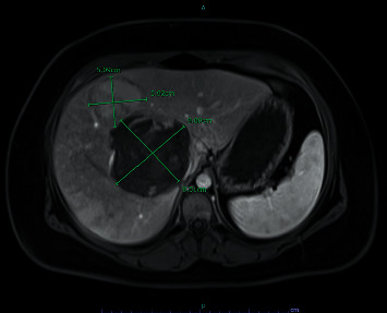 From an Incidental Finding to an Emergent Treatment: A Case Report of a Hepatic Adenomatosis and Large Ruptured Hepatic Adenoma.