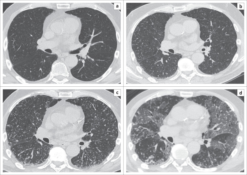 A unique case of miliary pulmonary tuberculosis induced by bacillus Calmette-Guérin intravesical instillation with COVID-19 superinfection.