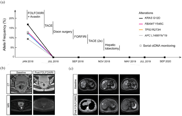 Clearance of circulating tumor DNA in a high-risk stage-IV rectal carcinoma patient with synchronous liver metastases after conversion surgery is correlated with pathologic complete response.