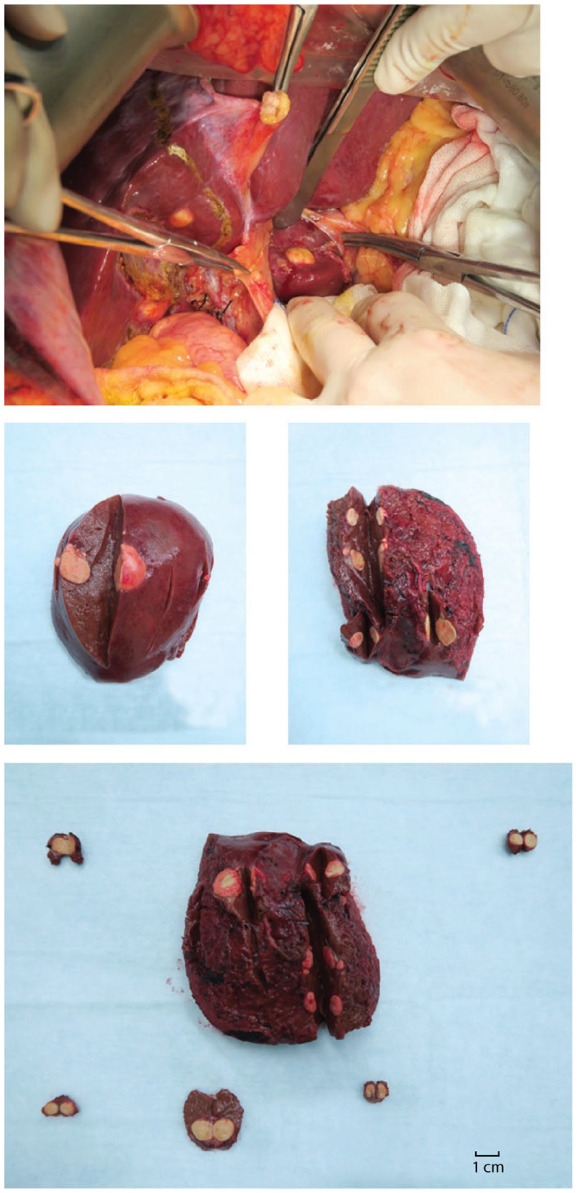 Clearance of circulating tumor DNA in a high-risk stage-IV rectal carcinoma patient with synchronous liver metastases after conversion surgery is correlated with pathologic complete response.