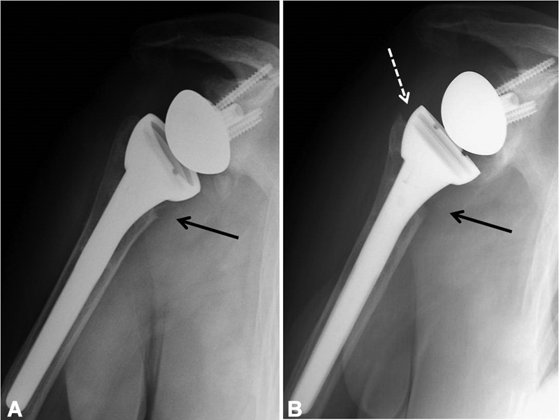 Short-Term Outcomes of the Grammont Reverse Shoulder Arthroplasty: Comparison between First and Second Generation Delta Prosthesis.