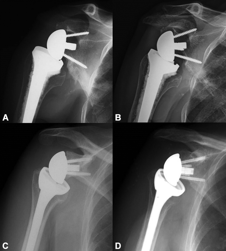 Short-Term Outcomes of the Grammont Reverse Shoulder Arthroplasty: Comparison between First and Second Generation Delta Prosthesis.