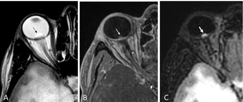 Value of Contrast-Enhanced FLAIR Images for the Depiction of Papilledema.