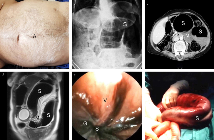 Sigmoid Volvulus: Diagnostic Modalities and Sigmoid Gangrene.