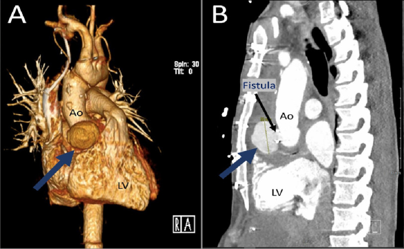 Rapidly expanding aortic root mycotic pseudoaneurysm with outflow tract fistula.