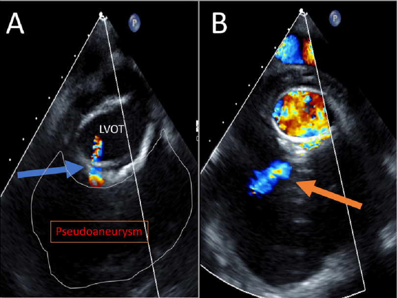 Rapidly expanding aortic root mycotic pseudoaneurysm with outflow tract fistula.