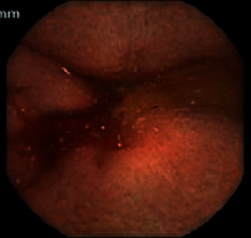 Management of Refractory Gastrointestinal Bleeding in Hereditary Hemorrhagic Telangiectasia with Bevacizumab.