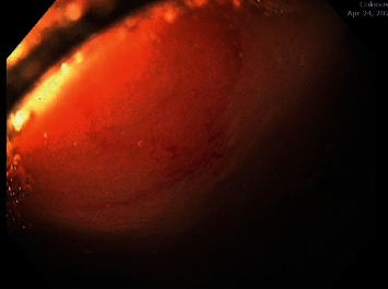 Management of Refractory Gastrointestinal Bleeding in Hereditary Hemorrhagic Telangiectasia with Bevacizumab.