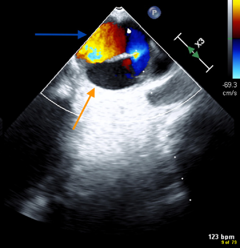 Rapidly expanding aortic root mycotic pseudoaneurysm with outflow tract fistula.