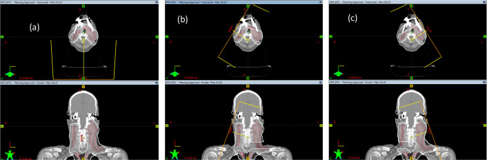A Review of the Robust Optimization Process and Advances with Monte Carlo in the Proton Therapy Management of Head and Neck Tumors.