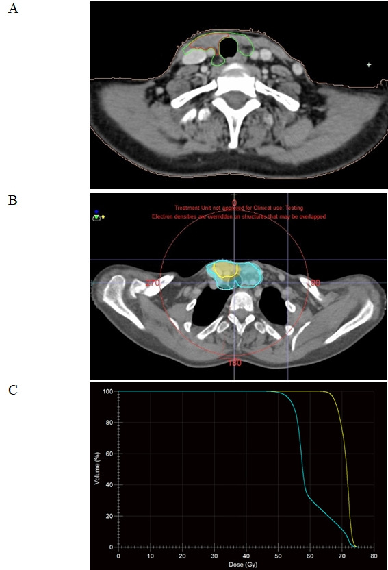 Intrathyroidal parathyroid carcinoma: a case report and literature review.