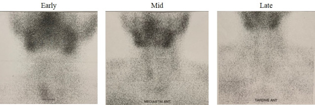 Intrathyroidal parathyroid carcinoma: a case report and literature review.