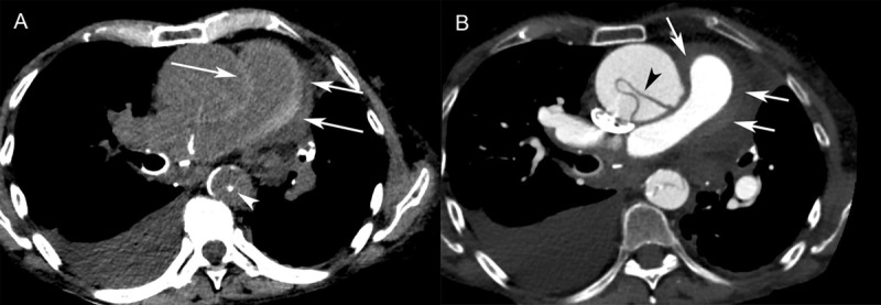 Case Series: Pulmonary Artery Intramural Hematoma in Stanford Type A Acute Aortic Dissection.