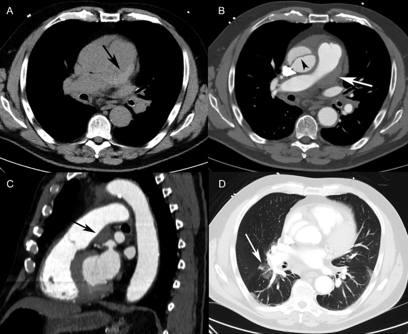 Case Series: Pulmonary Artery Intramural Hematoma in Stanford Type A Acute Aortic Dissection.