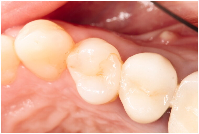 A three-year randomized clinical trial evaluating direct posterior composite restorations placed with three self-etch adhesives.