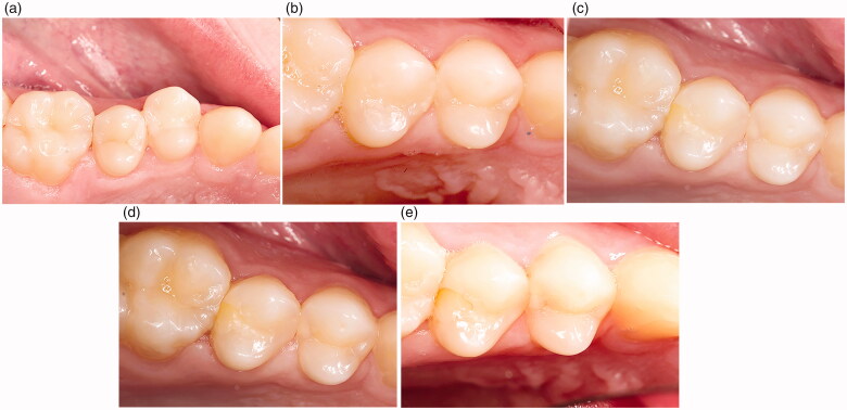 A three-year randomized clinical trial evaluating direct posterior composite restorations placed with three self-etch adhesives.