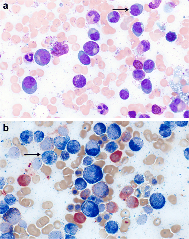 Differential Diagnosis and Workup of Monocytosis: A Systematic Approach to a Common Hematologic Finding.