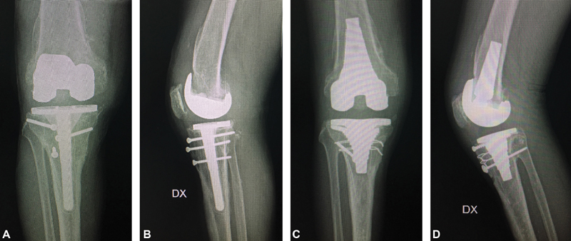 Porous-Coated Metaphyseal Sleeves in Revision Total Knee Arthroplasty: Midterm Results.