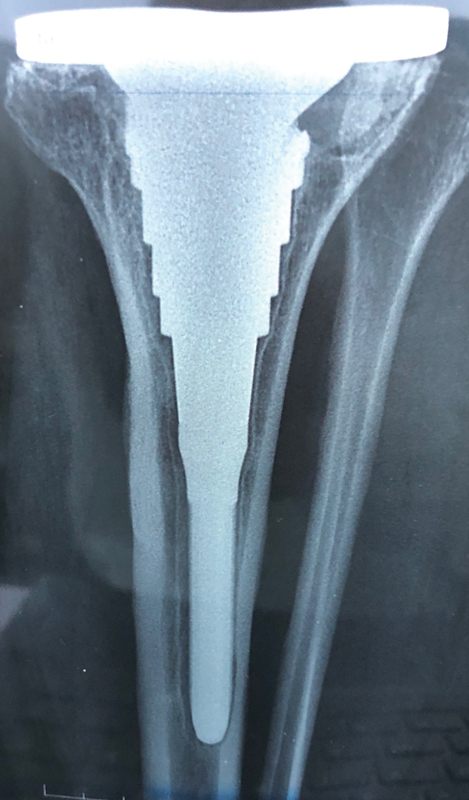 Porous-Coated Metaphyseal Sleeves in Revision Total Knee Arthroplasty: Midterm Results.