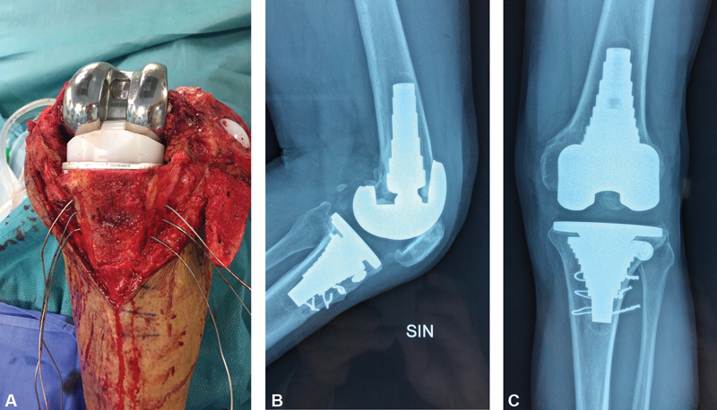 Porous-Coated Metaphyseal Sleeves in Revision Total Knee Arthroplasty: Midterm Results.