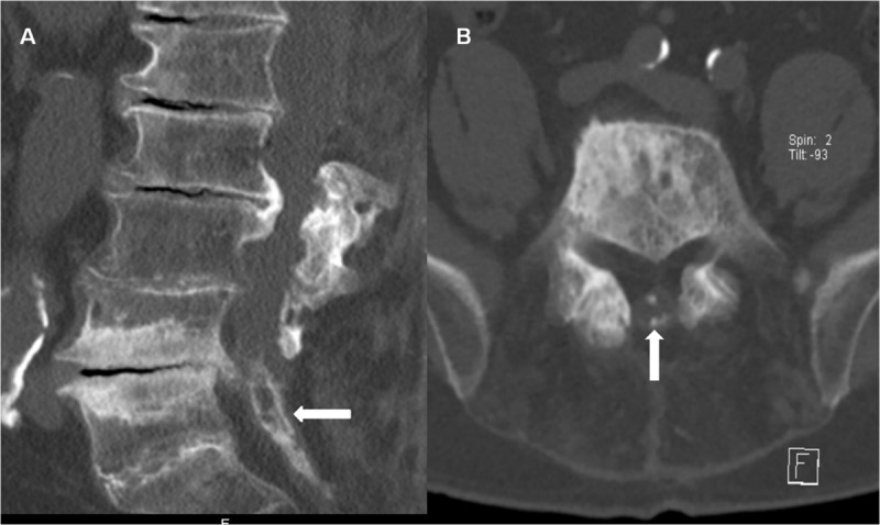 Arachnoiditis Ossificans.