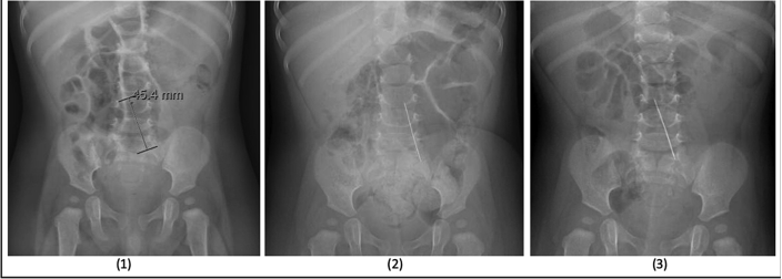 Incidental finding of a needle in the root of the mesentery of an 11-month-old boy: A case report