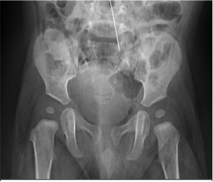 Incidental finding of a needle in the root of the mesentery of an 11-month-old boy: A case report