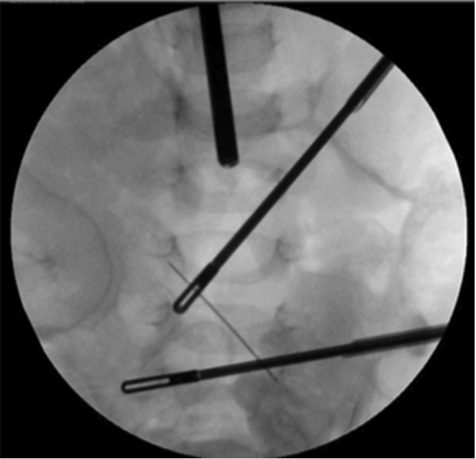 Incidental finding of a needle in the root of the mesentery of an 11-month-old boy: A case report