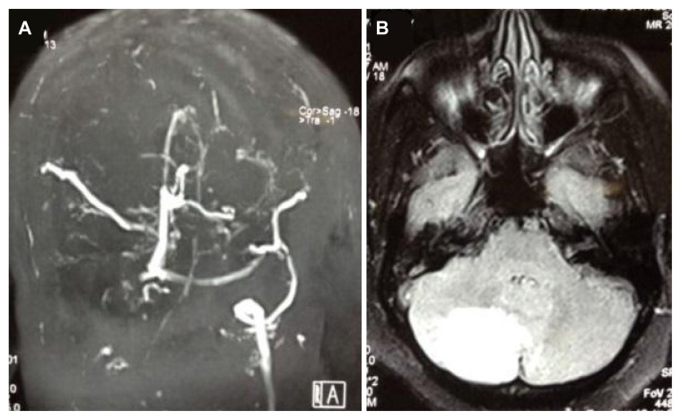 Posterior Reversible Encephalopathy Syndrome Is the Common Cause of New-Onset Seizures in the Peripartum Period: A Tertiary Hospital-Based Study in South India.