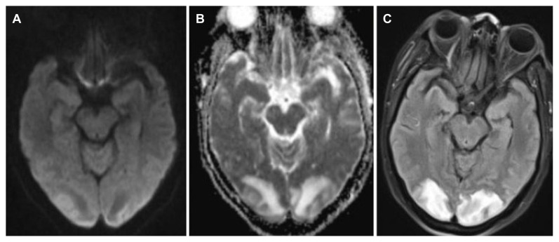 Posterior Reversible Encephalopathy Syndrome Is the Common Cause of New-Onset Seizures in the Peripartum Period: A Tertiary Hospital-Based Study in South India.