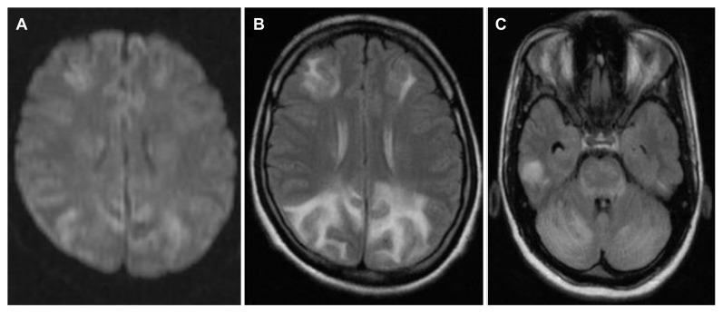 Posterior Reversible Encephalopathy Syndrome Is the Common Cause of New-Onset Seizures in the Peripartum Period: A Tertiary Hospital-Based Study in South India.