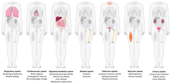 Rett syndrome: think outside the (skull) box.