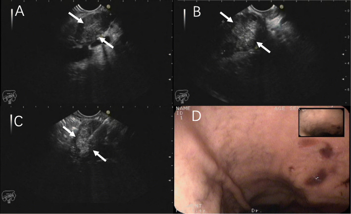 <sup>68</sup>Ga-FAPI-04 PET/MR is helpful in differential diagnosis of pancreatitis from pancreatic malignancy compared to <sup>18</sup>F-FDG PET/CT: a case report.