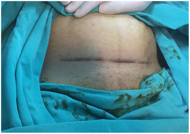 Predictors of the recurrence of surgically removed previous caesarean skin scars at caesarean section: A retrospective cohort study.