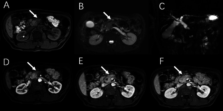 <sup>68</sup>Ga-FAPI-04 PET/MR is helpful in differential diagnosis of pancreatitis from pancreatic malignancy compared to <sup>18</sup>F-FDG PET/CT: a case report.