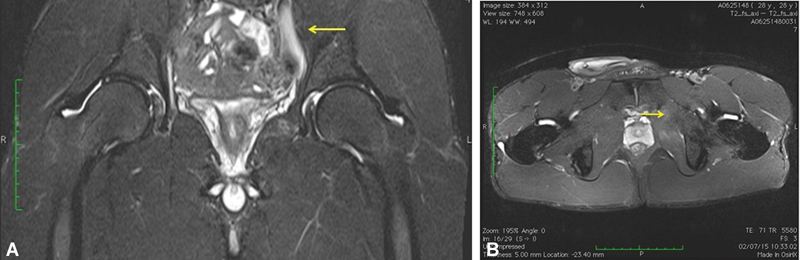 Acute Groin Pain Syndrome Due to Internal Obturator Muscle Injury in a Professional Football Player.