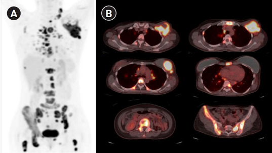 Abscopal effect after palliative five-fraction radiation therapy on bone and lymph node metastases from luminal B breast cancer: a case report and clinical implications for palliative radiation therapy.