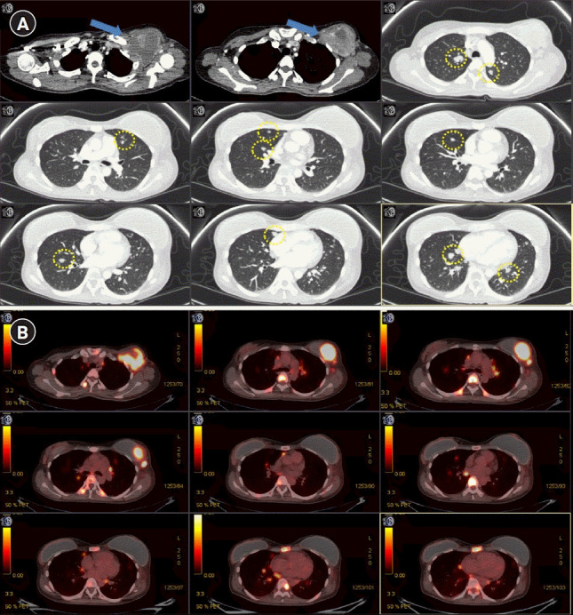 Abscopal effect after palliative five-fraction radiation therapy on bone and lymph node metastases from luminal B breast cancer: a case report and clinical implications for palliative radiation therapy.