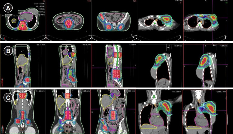 Abscopal effect after palliative five-fraction radiation therapy on bone and lymph node metastases from luminal B breast cancer: a case report and clinical implications for palliative radiation therapy.