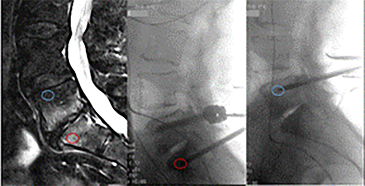 Pro-fibrotic phenotype of bone marrow stromal cells in Modic type 1 changes.