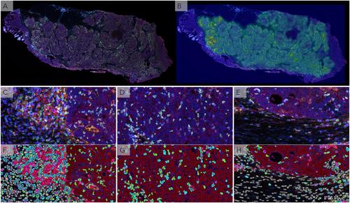 Immunological tumor heterogeneity and diagnostic profiling for advanced and immune therapies