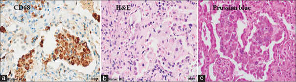 Fatal rapidly progressive interstitial lung disease in a patient with amyopathic dermatomyositis.