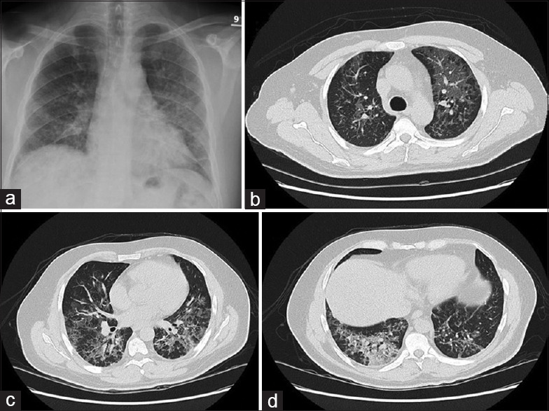 Fatal rapidly progressive interstitial lung disease in a patient with amyopathic dermatomyositis.