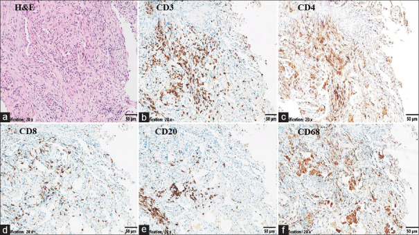 Fatal rapidly progressive interstitial lung disease in a patient with amyopathic dermatomyositis.