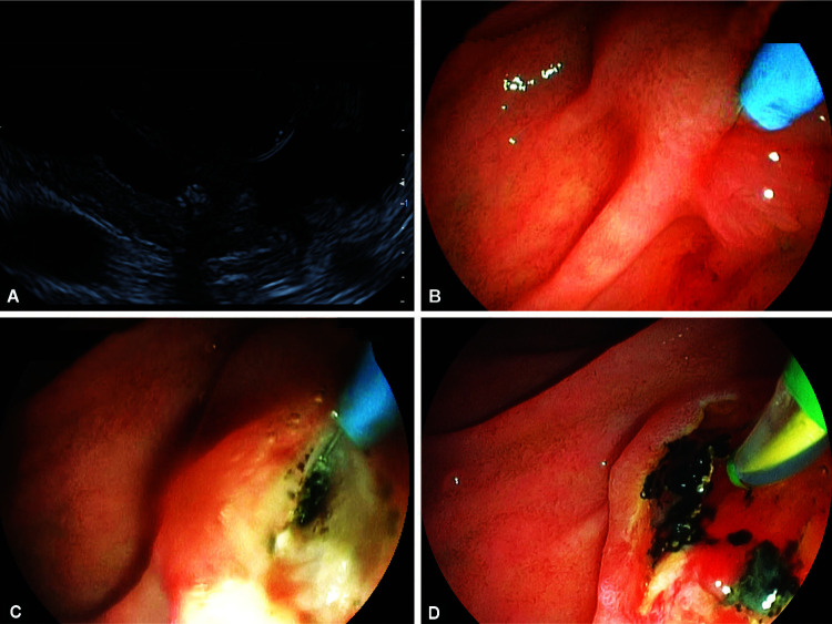 "Lever Technique": A Novel Approach to Cope with Unstable Scope Position during Bottom-up Needle Knife Access (with Video).