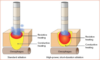 The Cutting Edge of Atrial Fibrillation Ablation.